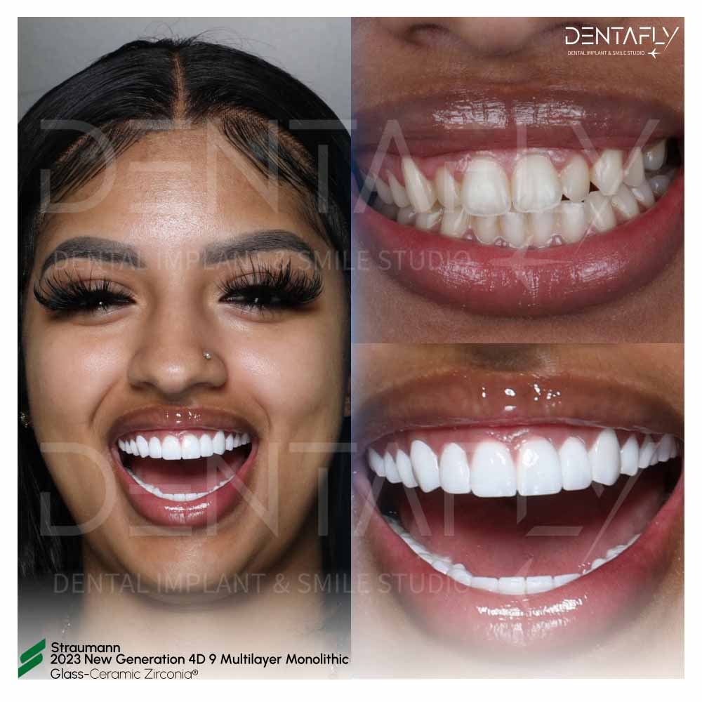 Before After Zirconia Crown
