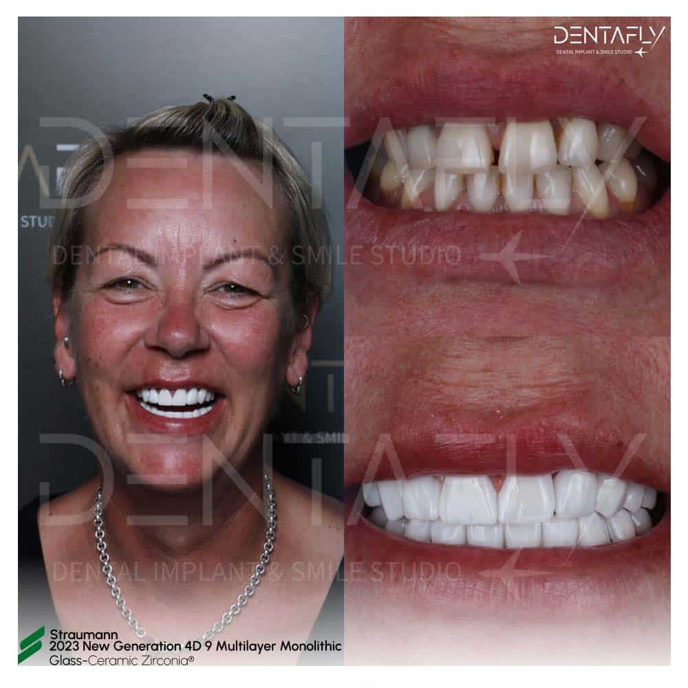 Before After Smile Design