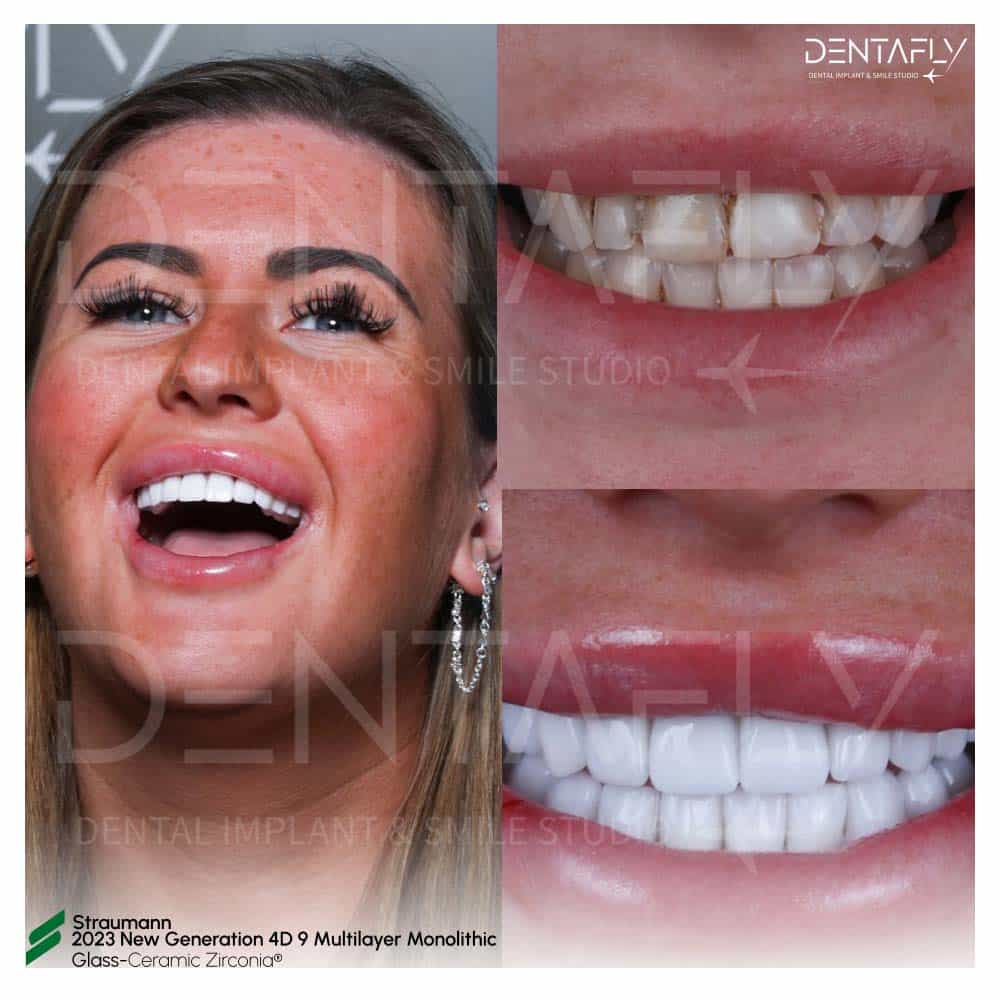 Before After Zirconia Crown