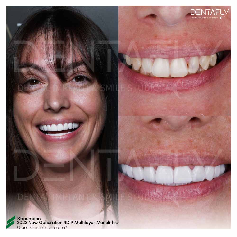 before-after-zirconia-crown before-after-zirconia-crown