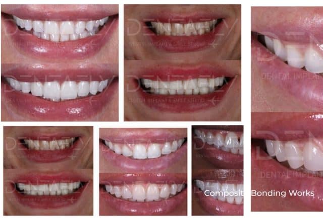 Composite Bonding Cases in 2024