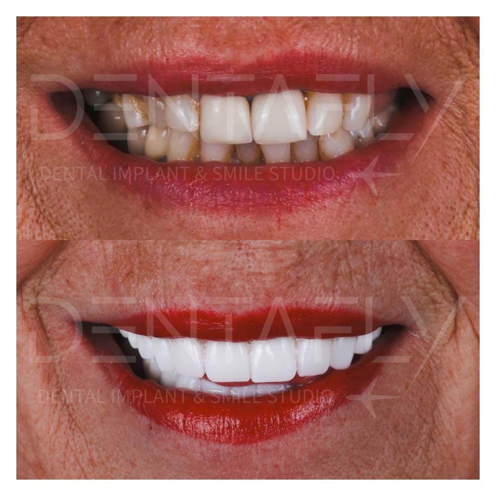 50+ years old female patient who had all on 6 treatment
