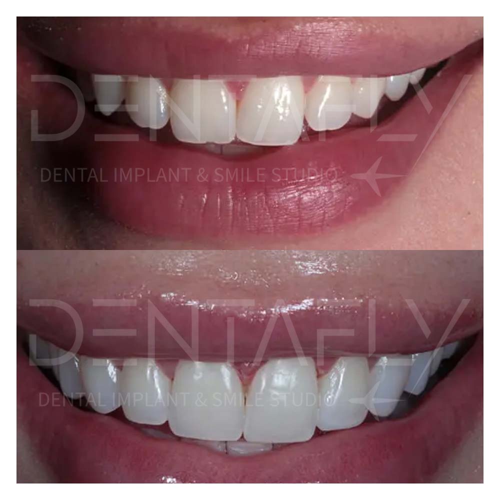 composite-bonding-before-after-10