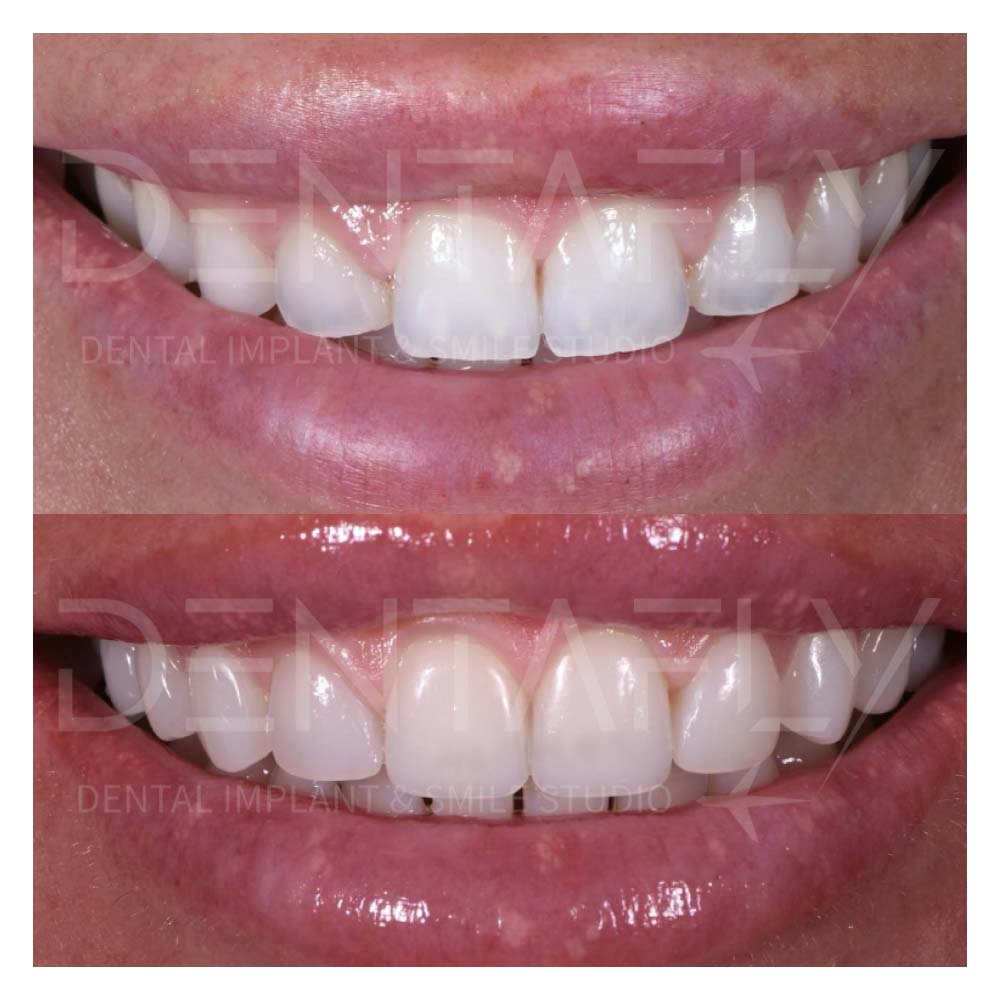 composite-bonding-before-after-12