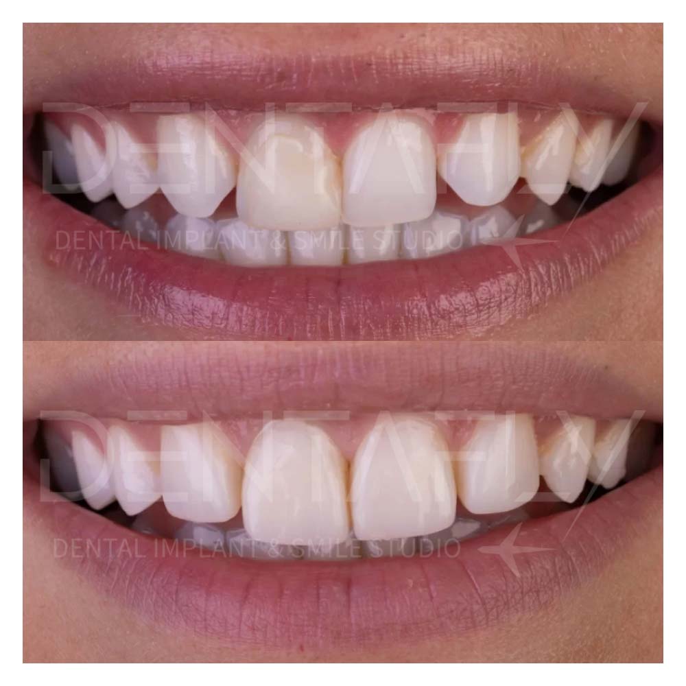 composite-bonding-before-after-14