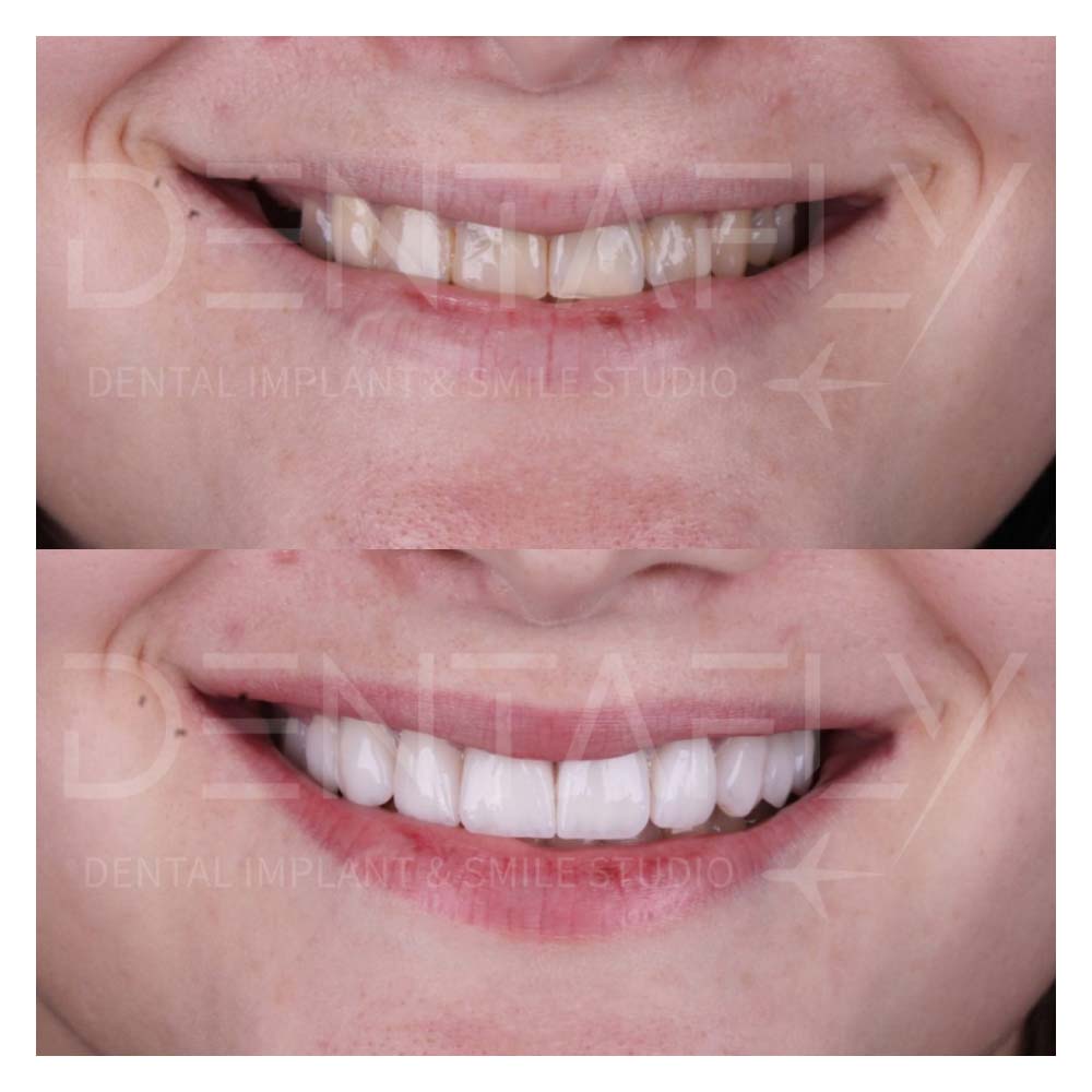 composite-bonding-before-after-15