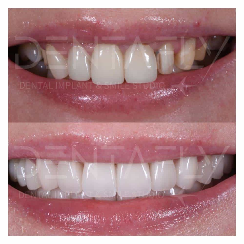 composite-bonding-before-after-16