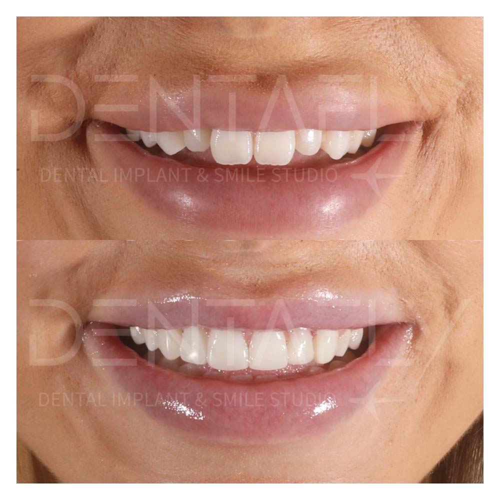 composite-bonding-before-after-17