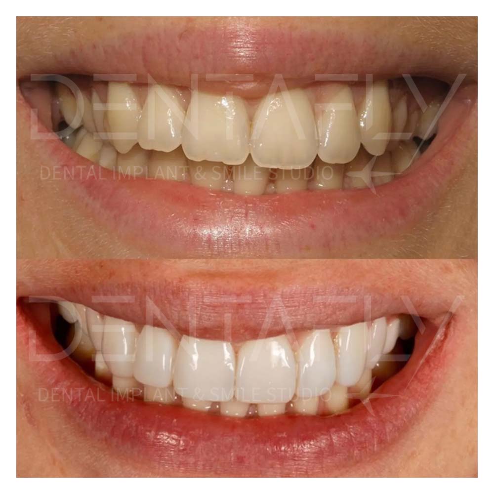 composite-bonding-before-after-18