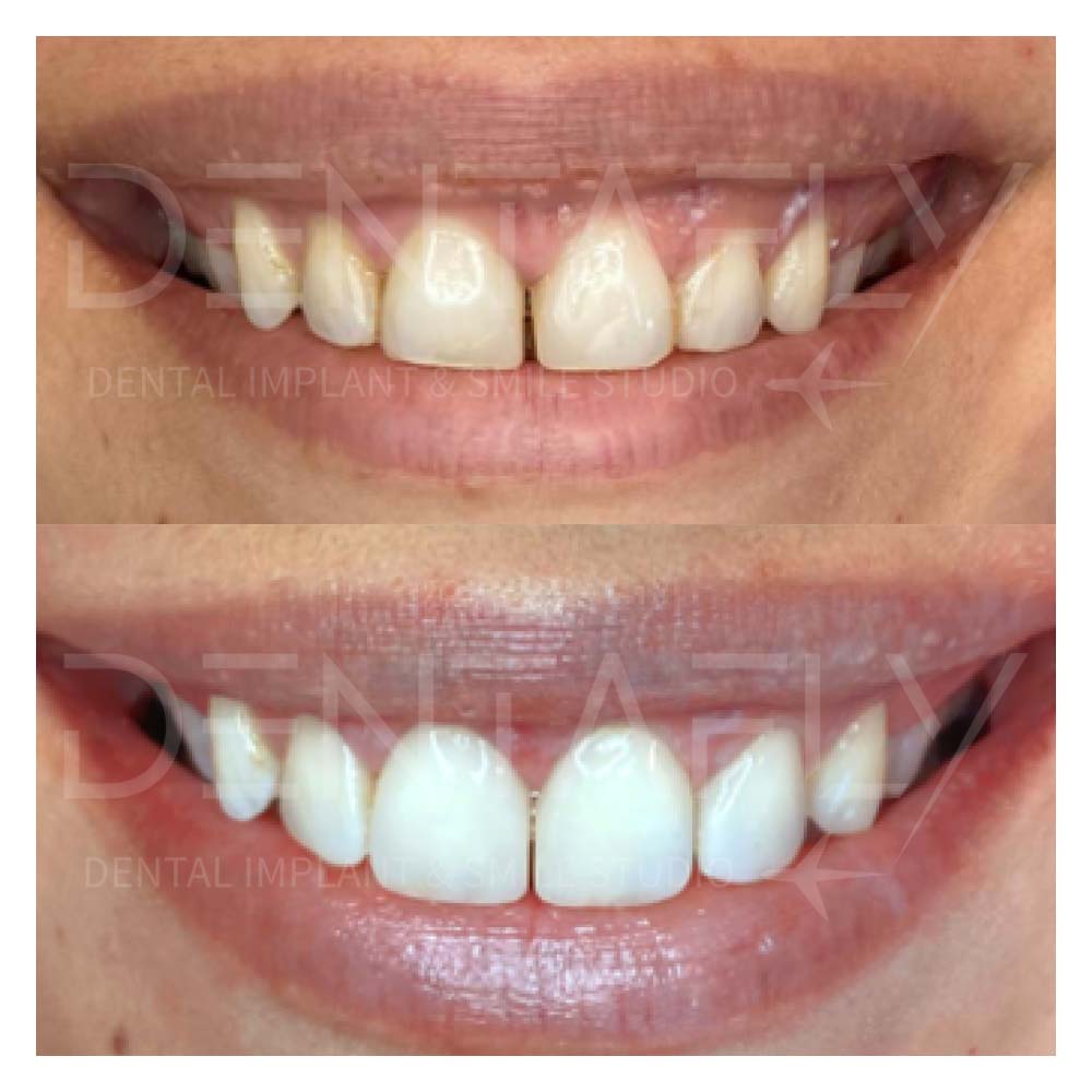 composite-bonding-before-after-19