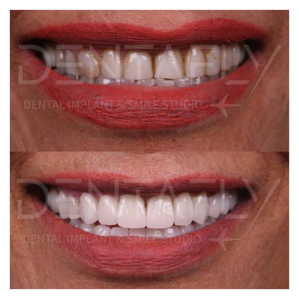 composite-bonding-before-after-20