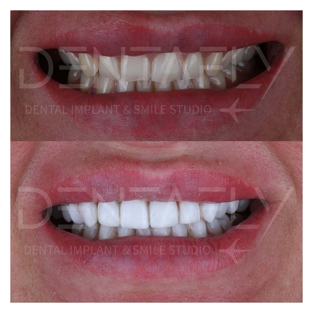 composite-bonding-before-after-6