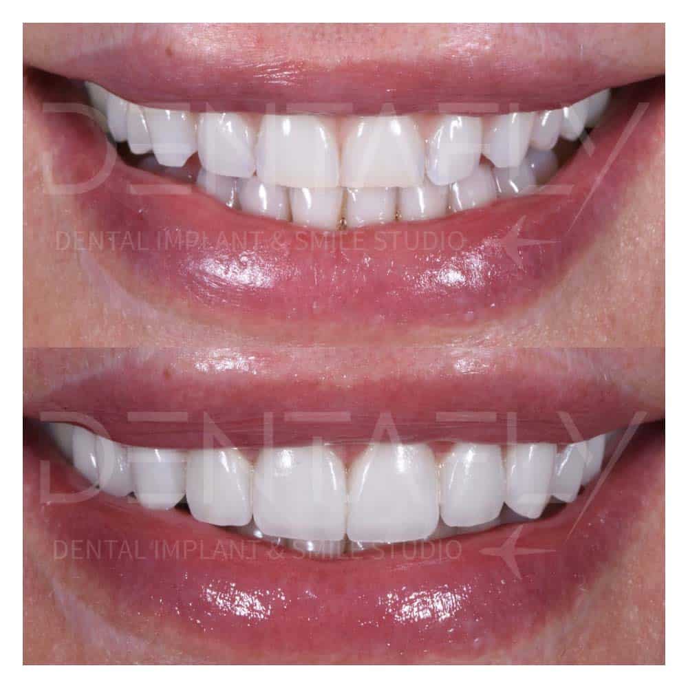 composite-bonding-before-after-7