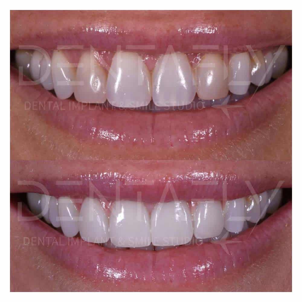 composite bonding before after-8