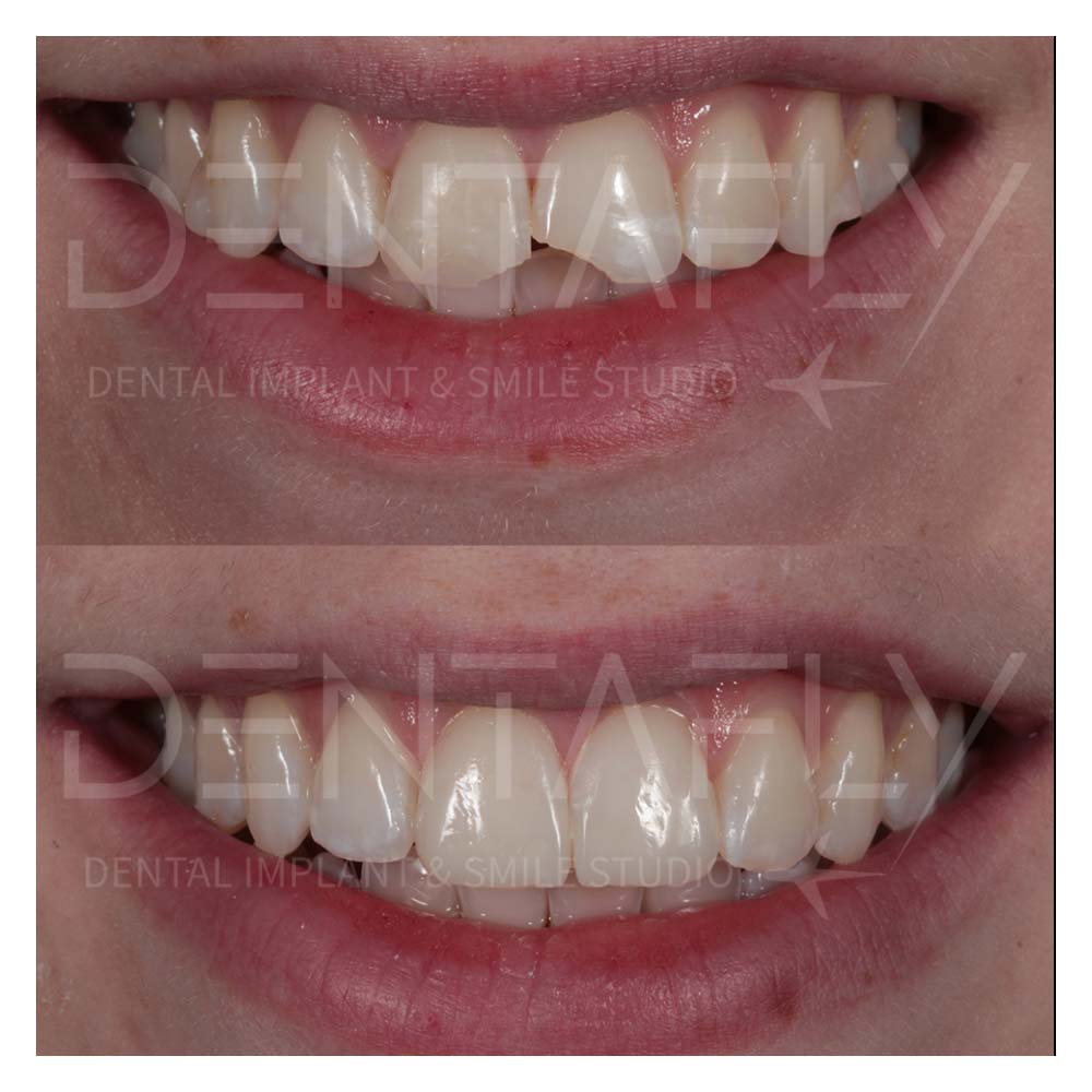 composite-bonding-before-after-9