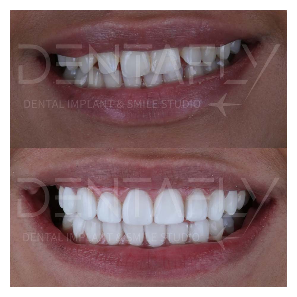 composite-bonding-before-after-antalya