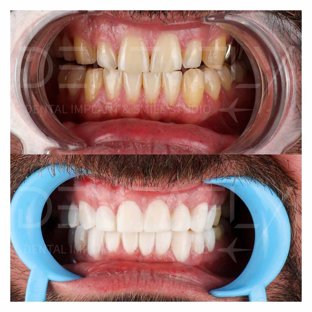 composite-bonding-before-after-dentafly