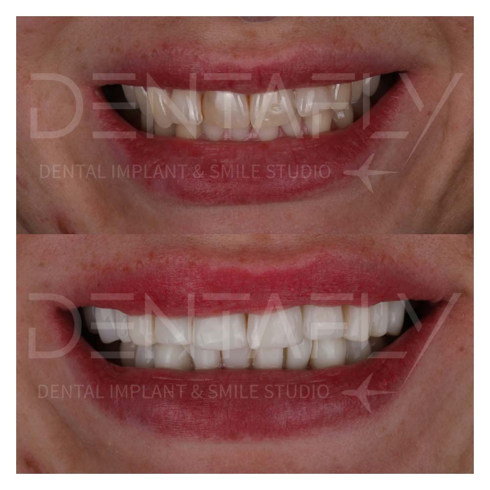 composite bonding before after istanbul