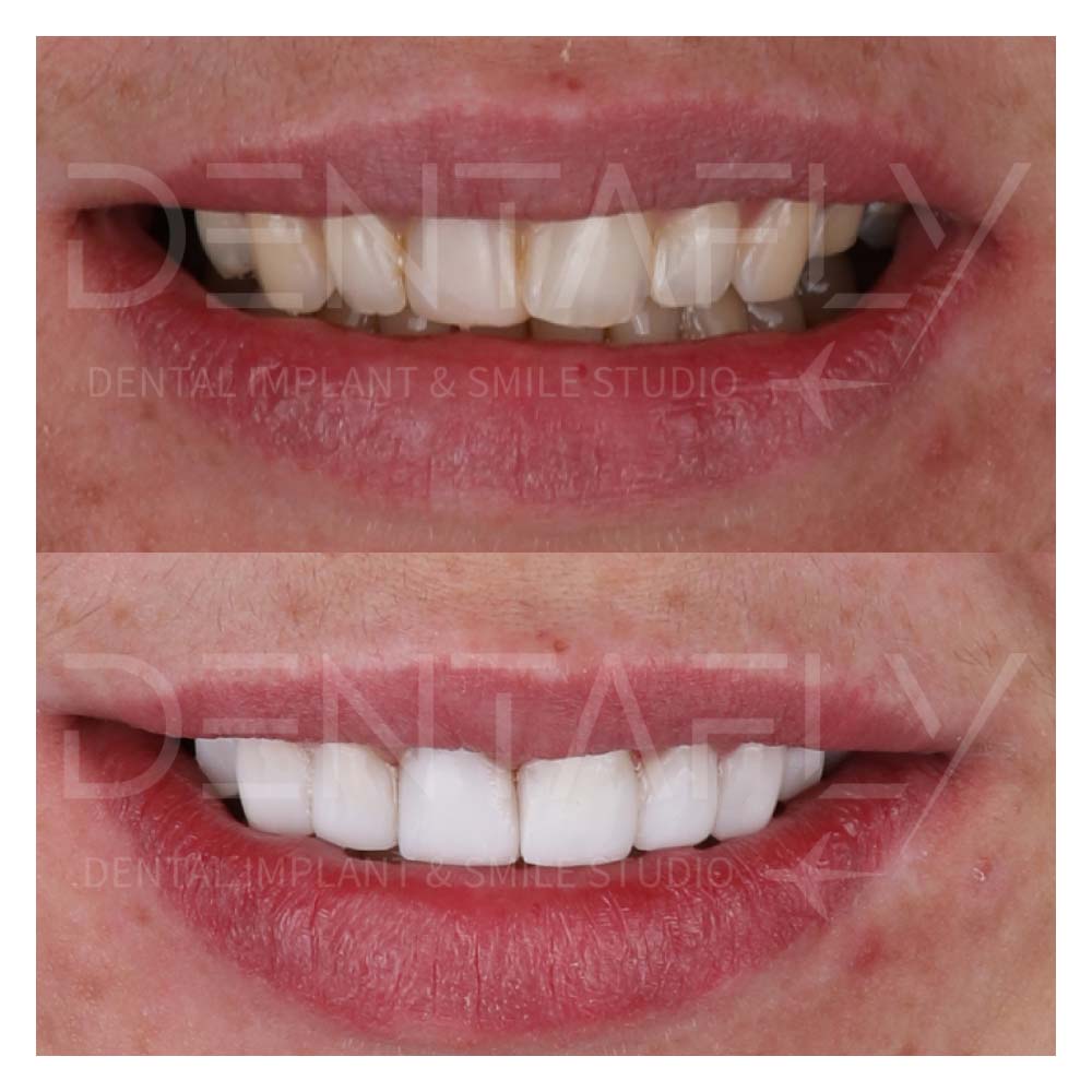 composite-bonding-before-after-izmir