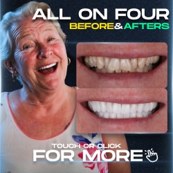 All on Four Before After gallery