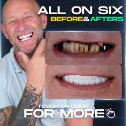 All on 6 Before After Photos