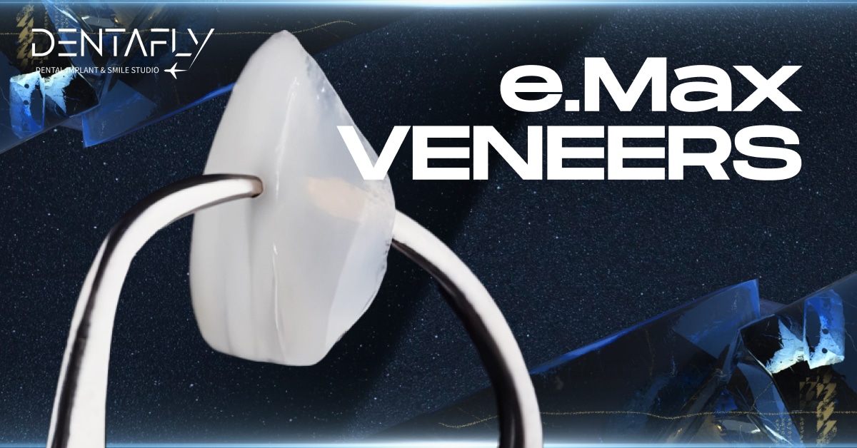 e Max dental veneers
