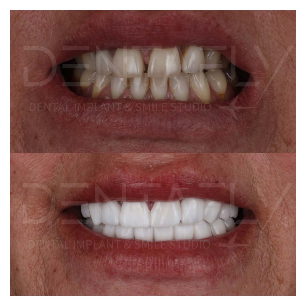 Zirconium Crowns Before After