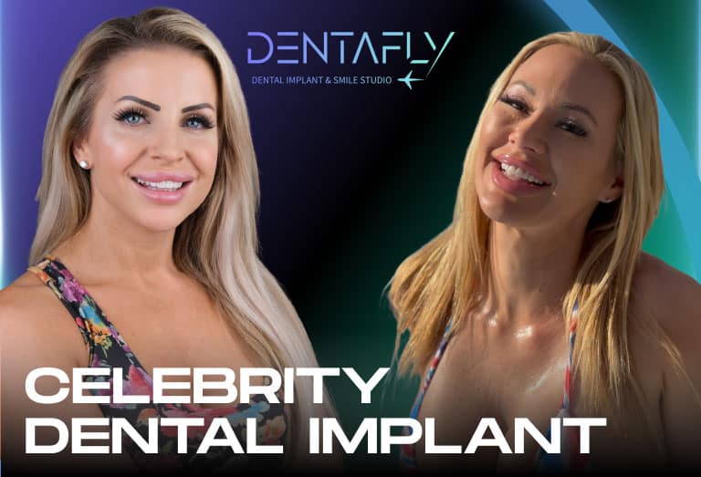 Celebrity Dental Implants