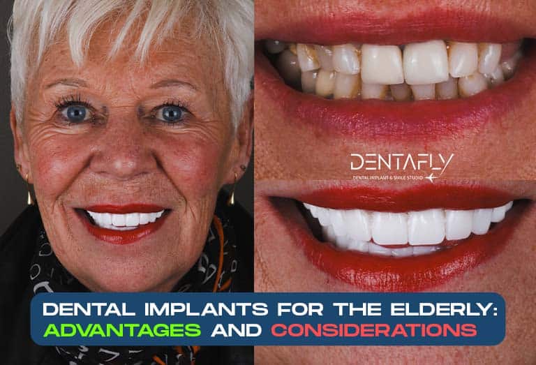 Implants-for-the-Elderly-Advantages-and-Considerations Dental implant treatment for a lady 65+ years old