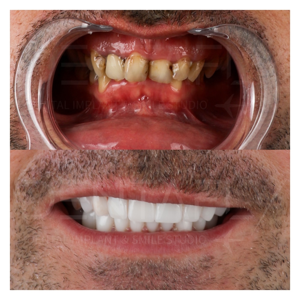 fullmouth full mouth reconstruction in Turkey