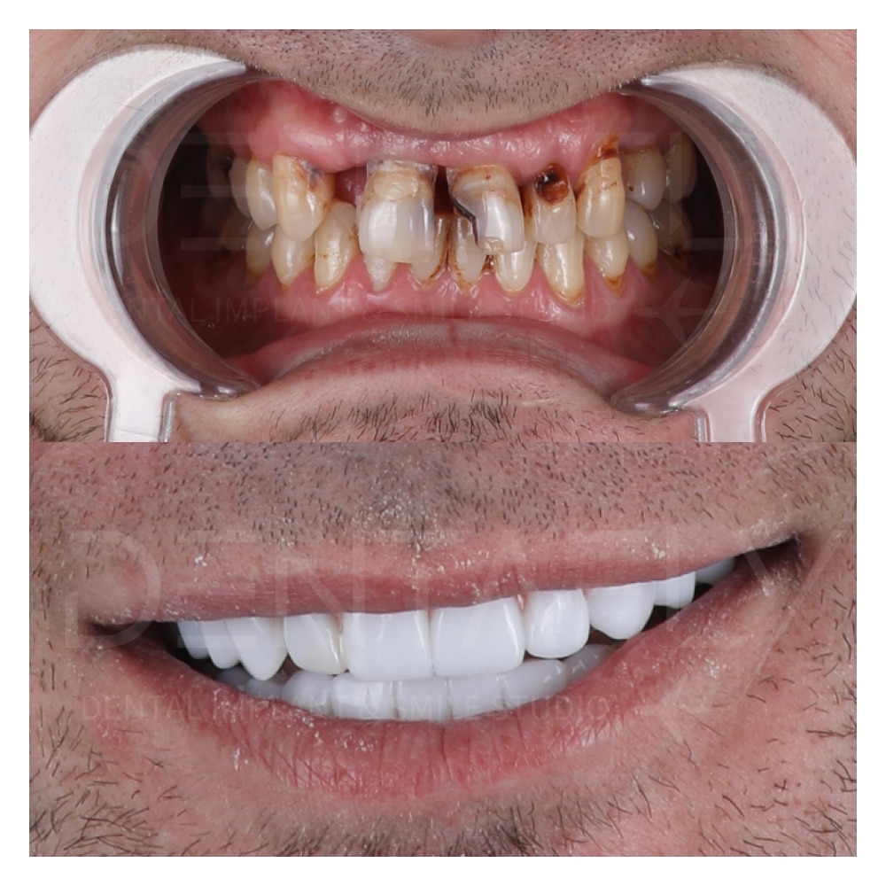 fullmouth1 full mouth procedure, frontal zone fixed