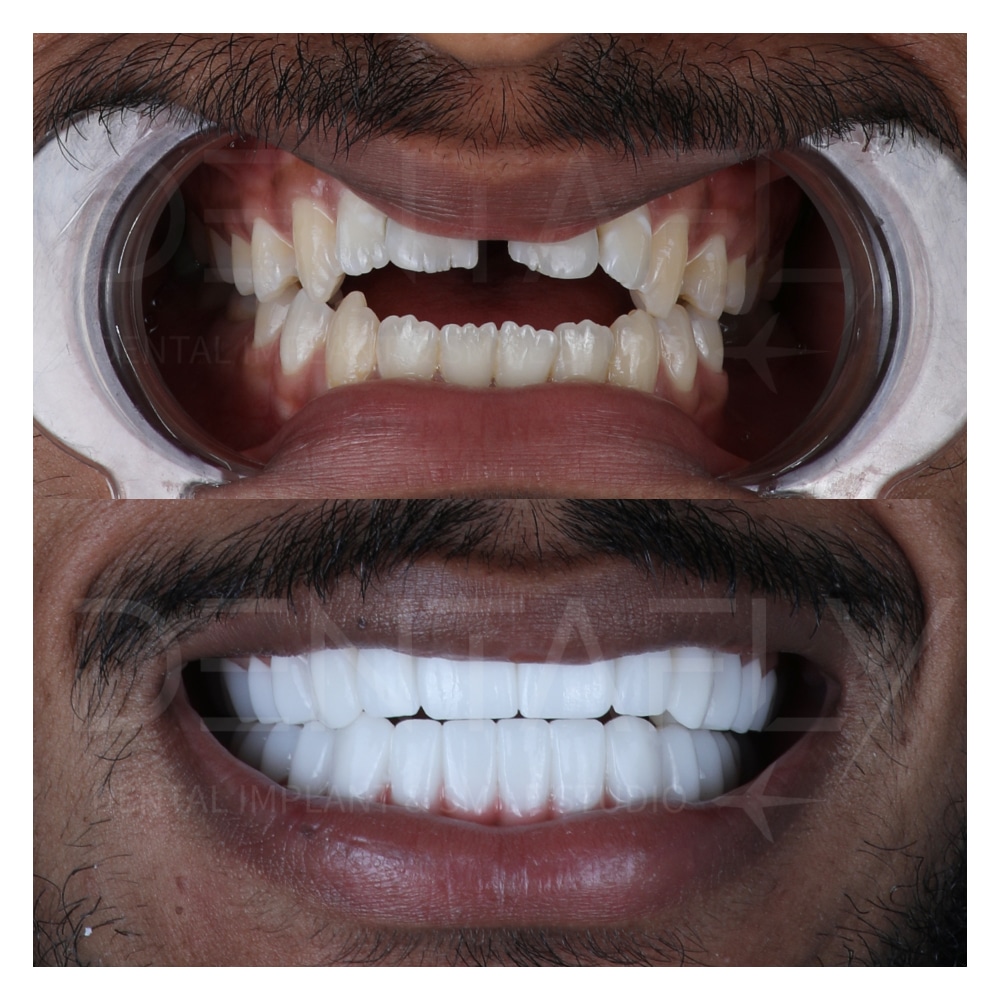 fullmouth2 Gum line and frontal line of teeth fixed