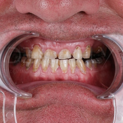 before-new-teeth before-new-teeth