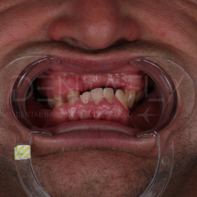 eligible-for-implants eligible-for-implants