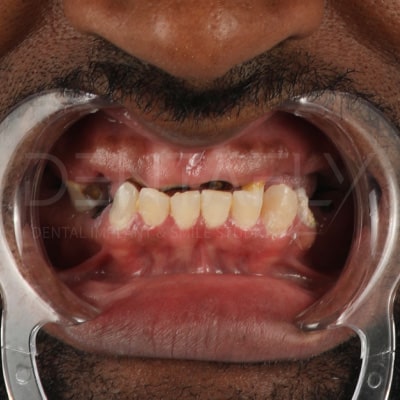 implant-before-3 implant-before-3