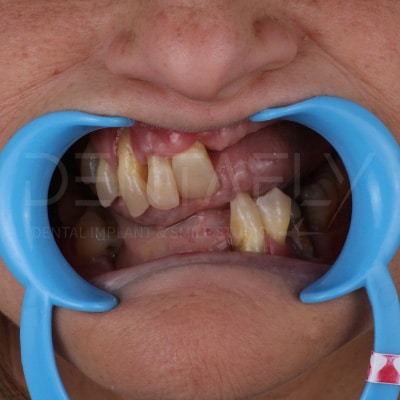 implant-before-4 implant-before-4