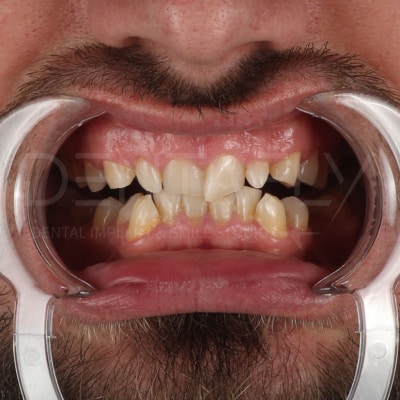 smile-design-before-1 smile-design-before-1