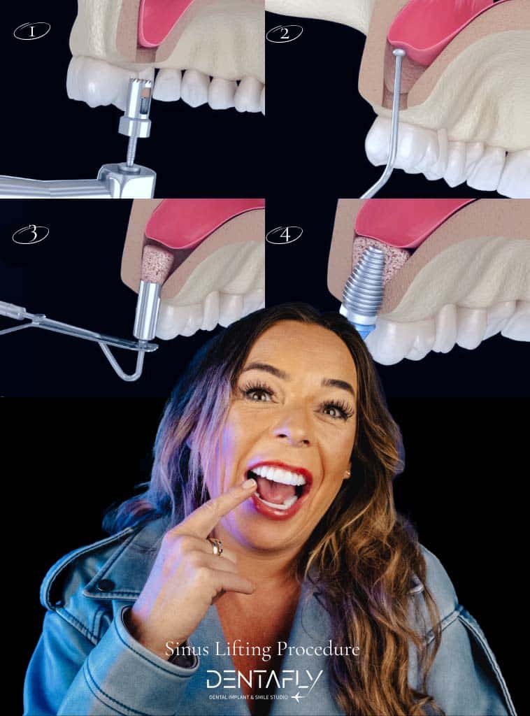 sinus-lifting-procedure