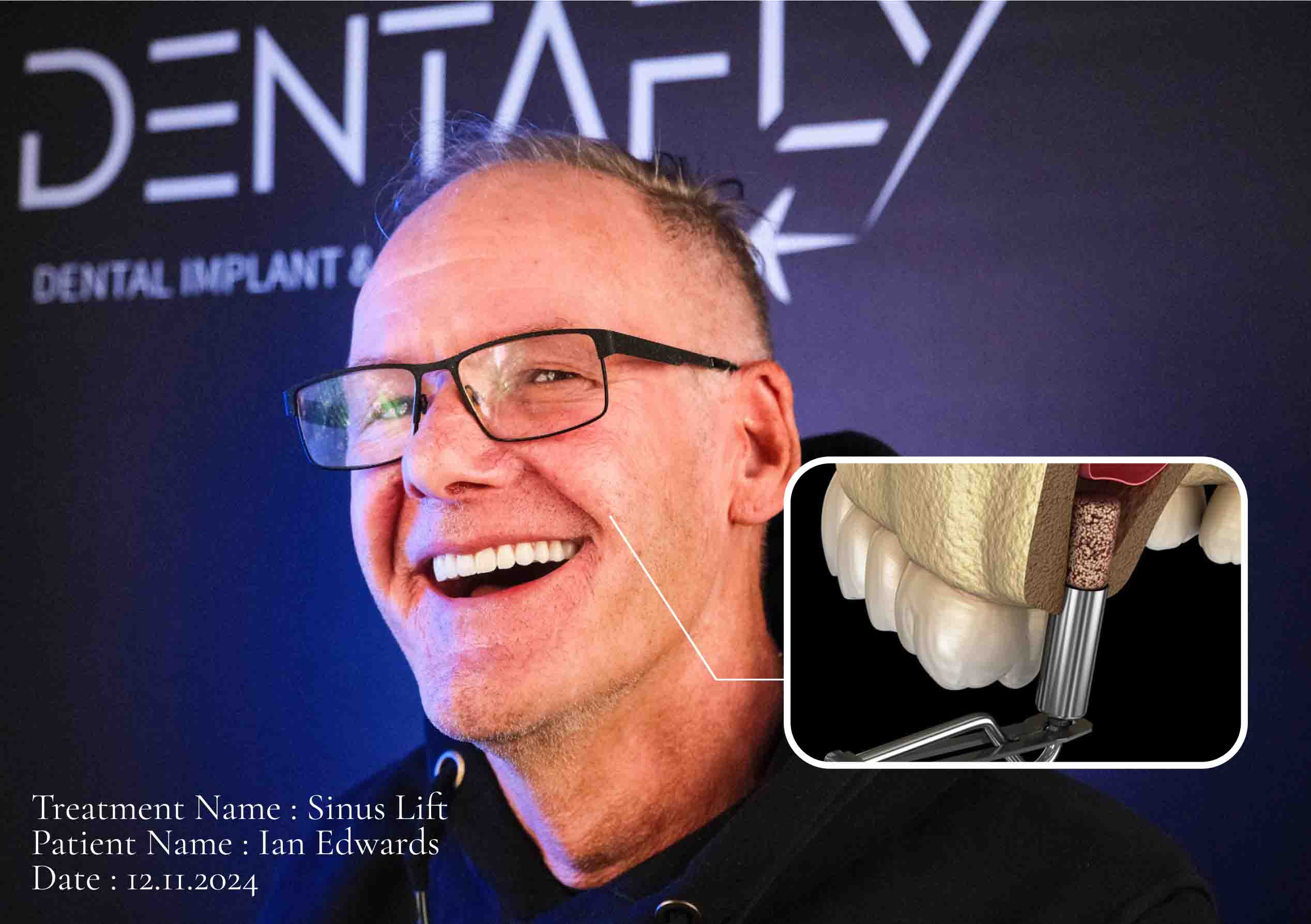 treatment-sinus-lift