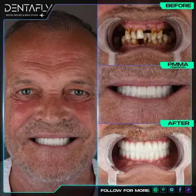 cliffs-dental-implantreview-640x640.jpg All on Treatment in Dentafly Turkey