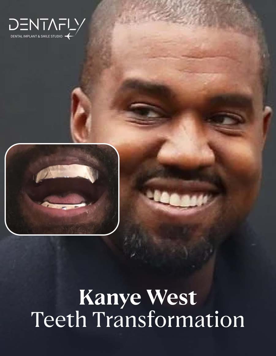Kanye West's Teeth Transformation