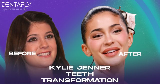 Kylie Jenner's Teeth Transformation SOLVED