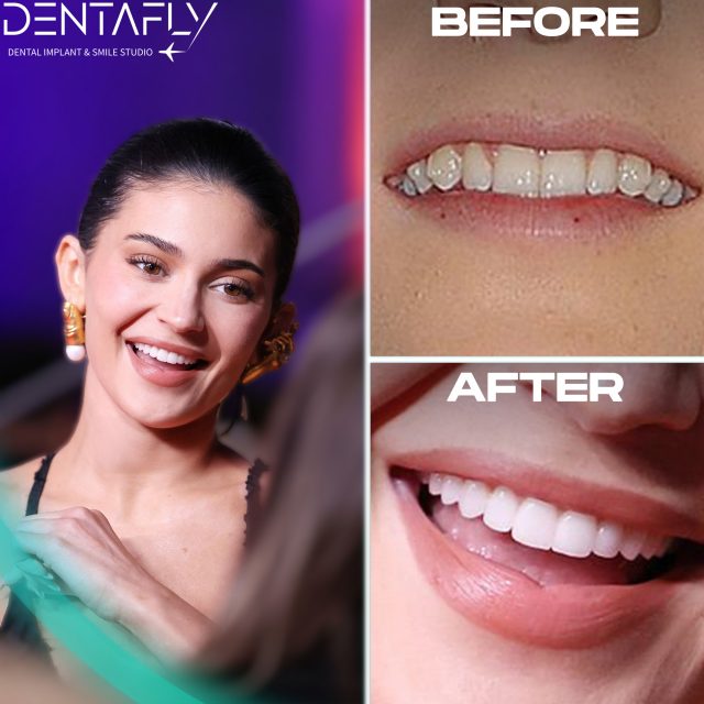 Kylie Jenner's brilliant teeth secret