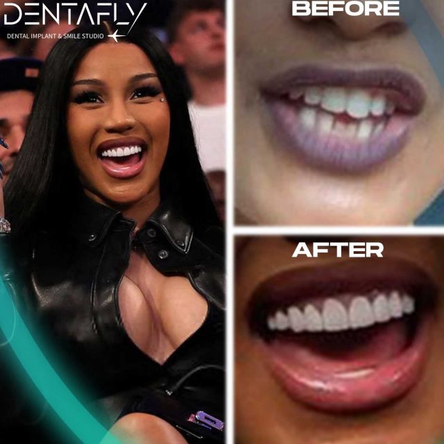 Before and After of Cardi B teeth